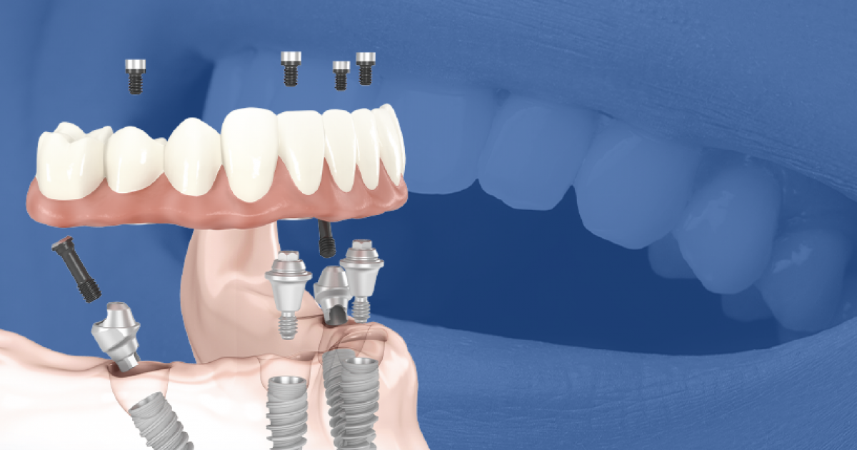 Discover the LifeChanging Benefits of Allon4 Dental Implants in Mexico